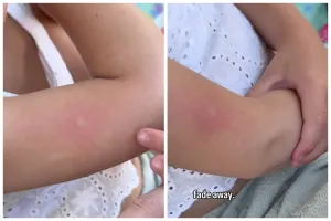 Cara atasi gatal bekas gigitan nyamuk di kulit cuma andalkan 1 sampah dapur, ampuh tanpa berbekas