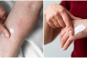 Hati-hati bertukar pakaian ke orang lain, kenali penyakit kurap, gejala, penyebab, dan cara mengatasi