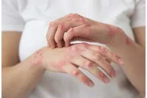 Wabah cacar monyet Mpox muncul di Indonesia, 9 makanan ini bantu proses penyembuhan lebih cepat