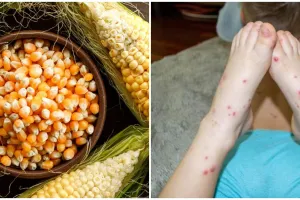 Jangan disepelekan, ini alasan jagung parut bahaya untuk penderita cacar