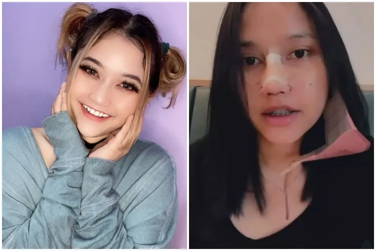 7 Potret before after selebgram usai oplas ini manglingi Berbagai sumber 7 Potret before after selebgram usai oplas ini manglingi Berbagai sumber