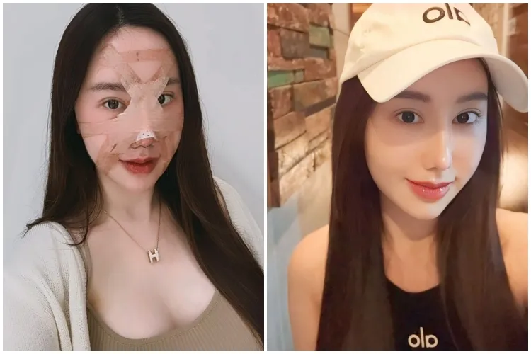 7 Potret before after selebgram usai oplas ini manglingi Berbagai sumber 7 Potret before after selebgram usai oplas ini manglingi Berbagai sumber