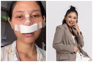 Riyuka Bunga oplas hidung demi tampil lebih cantik, pahami apa itu rhinoplasty dan bahayanya