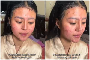 Kena cacar air H-3 menikah, transformasi wajah cewek penuh bekas luka ini hasilnya jadi mulus pol