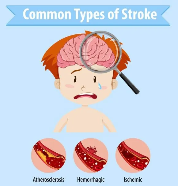 Apa itu stroke iskemik © 2024 brilio.net Apa itu stroke iskemik © 2024 brilio.net