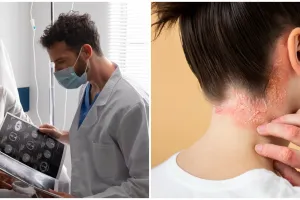 Tak hanya mengganggu penampilan, 7 risiko kesehatan akibat psoriasis
