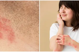 Herpes zoster mulai merebak, waspadai gejala awal untuk penanganan dini