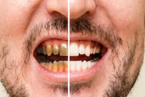 Cangkang telur dicampur 2 bahan dapur efektif bersihkan noda kuning pada gigi, ini cara mengolahnya