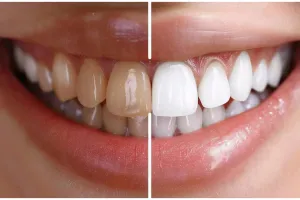 Cara mudah memutihkan gigi dalam 5 menit secara alami tanpa baking soda, cukup pakai 2 bahan dapur