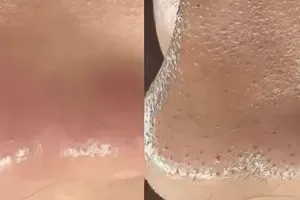 Cara bersihkan pori-pori tersumbat penyebab komedo pakai 1 jenis tepung, tanpa lemon dan kopi 