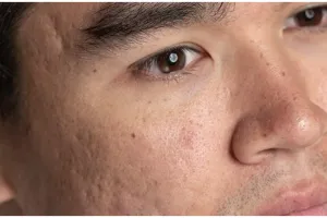 Trik mengecilkan pori-pori agar wajah bebas minyak pakai 1 jenis bunga, tanpa timun dan air mawar 