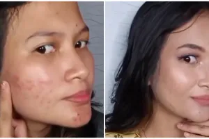 Tanpa color corrector, ini trik menutup bekas jerawat agar complexion lebih rata dan tak abu-abu