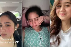 6 Potret Tissa Biani 4 tahun jadi pejuang jerawat, kerap nangis saat bercermin, ajarkan kesabaran