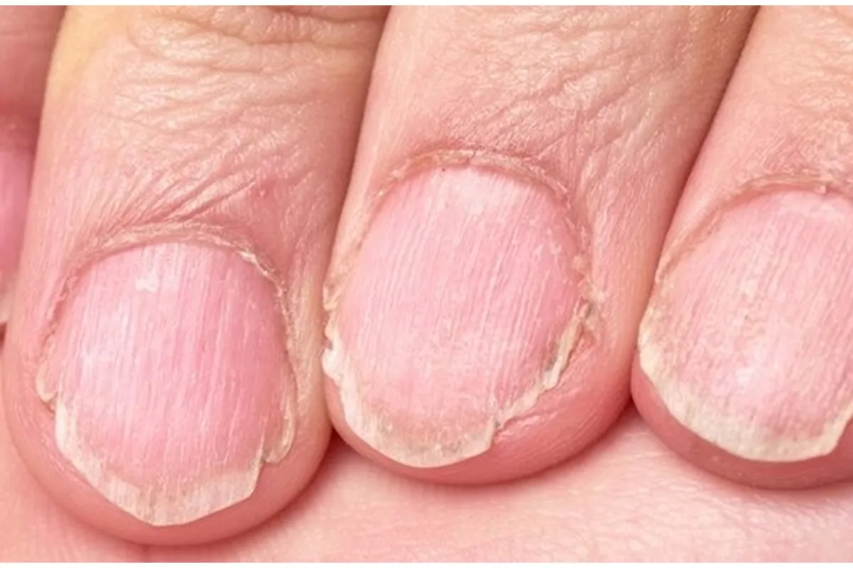 Cara atasi jamur kuku menguning dengan 1 bahan dapur, nggak perlu lagi pakai kutek