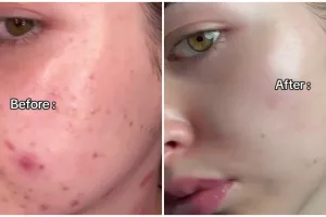 Bekas jerawat meradang? Begini cara menghilangkannya cuma dengan masker dari 3 bahan dapur