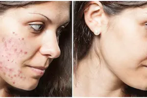 Cara hilangkan bekas jerawat dan komedo di pori-pori tanpa produk peeling, ampuh pakai 1 bahan makanan