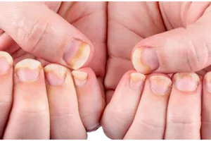 Jamur di kuku hilang dalam seminggu, ini cara mengatasinya secara alami cuma dengan 1 bumbu dapur