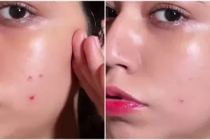 Cara cepat memudarkan bekas jerawat dalam sekejap cuma dengan 2 bahan dapur