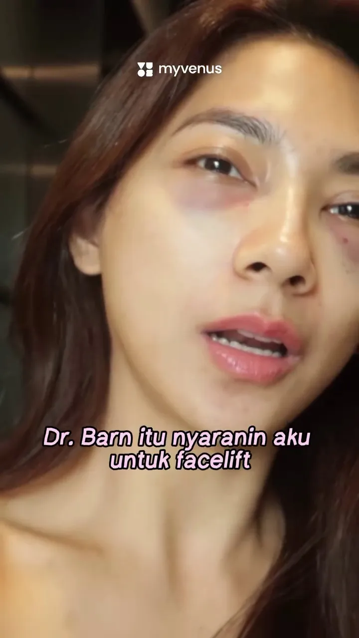 dinda kirana jalani oplas wajah dan badan  © 2025 Instagram