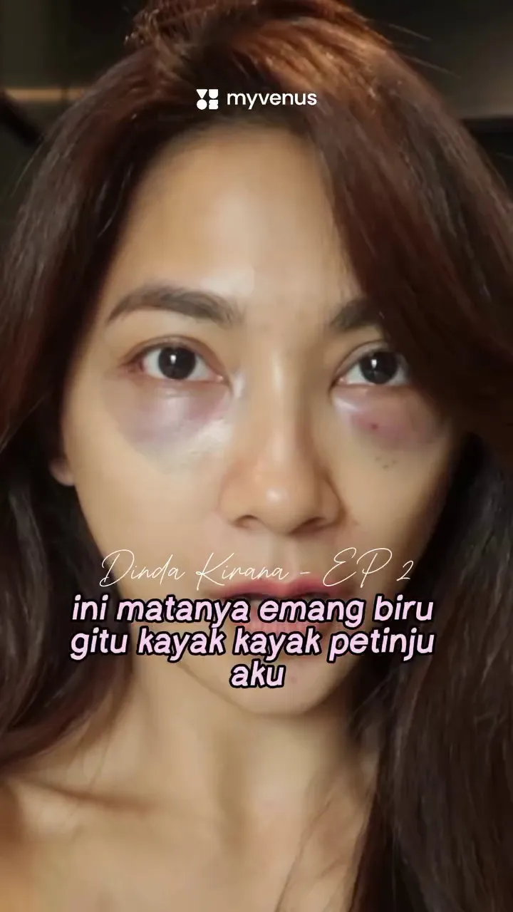 dinda kirana jalani oplas wajah dan badan  © 2025 Instagram