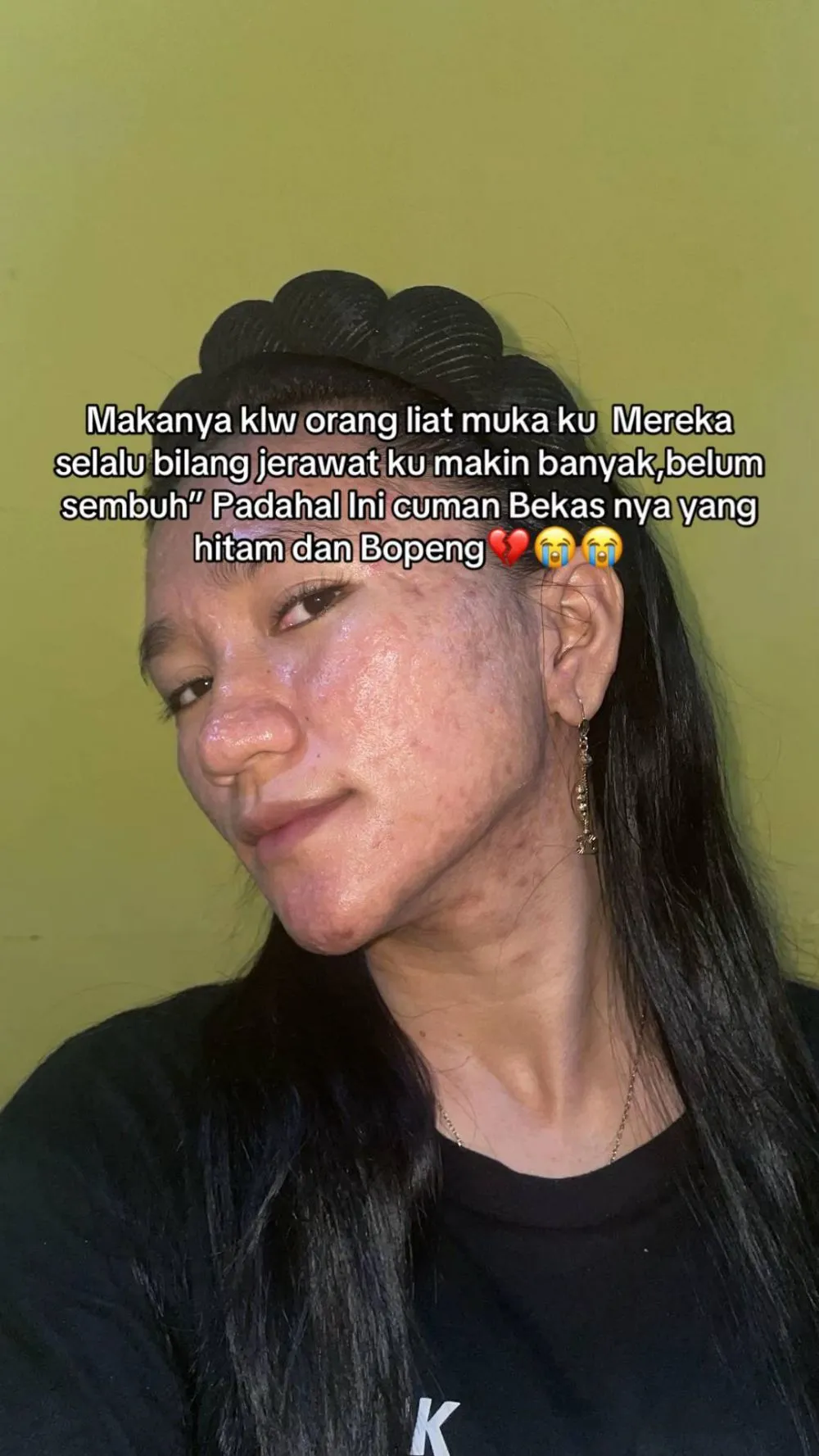 wajah wanita mulus jadi penuh bopeng © TikTok wajah wanita mulus jadi penuh bopeng © TikTok