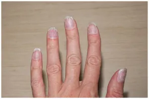 Kuku sering patah dan jamuran? Ini cara ampuh mengatasinya cuma dengan 2 bahan dapur