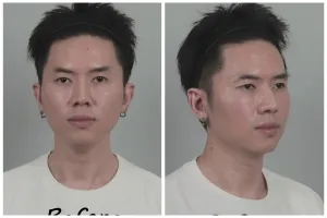 9 Potret transformasi Rafael Tan usai jalani oplas, perubahannya matanya jadi sorotan