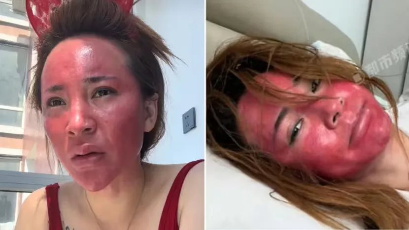 Wanita tak hapus makeup wajah jadi meradang © 2025 Weibo Wanita tak hapus makeup wajah jadi meradang © 2025 Weibo