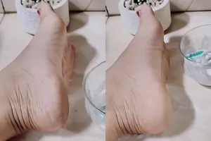 Tak perlu direndam air hangat, begini cara bikin tumit pecah-pecah jadi mulus cuma dengan 2 tanaman