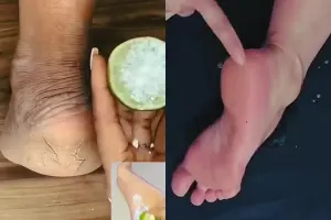 Jangan dikikis, scrub dari 2 bahan dapur ini ampuh bikin tumit pecah-pecah jadi mulus lagi