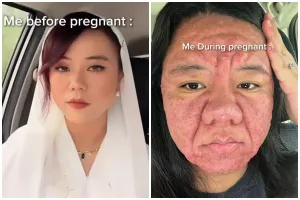 Wanita ini alami perubahan pada wajahnya saat hamil, usahanya berjuang untuk sembuh banjir simpati