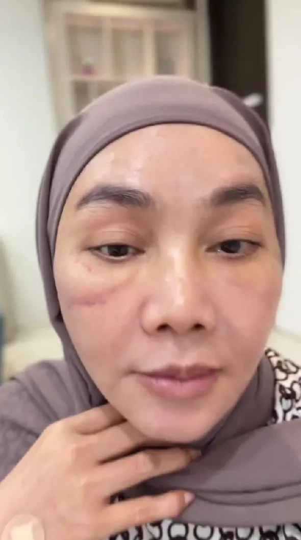 Dewi Gita rogoh ratusan juta demi oplas © Instagram Dewi Gita rogoh ratusan juta demi oplas © Instagram