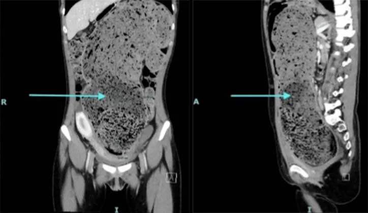 Wanita tidak BAB 4 bulan isi perut seperti tanah liat © 2025 brilio.net