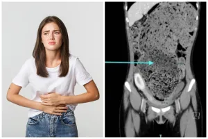 Kisah wanita tak BAB 4 bulan, dokter ungkap kondisi perutnya bak dipenuhi tanah liat