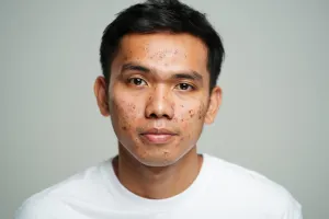 10 Skincare cowok penghilang bekas jerawat harga di bawah Rp 100 ribu