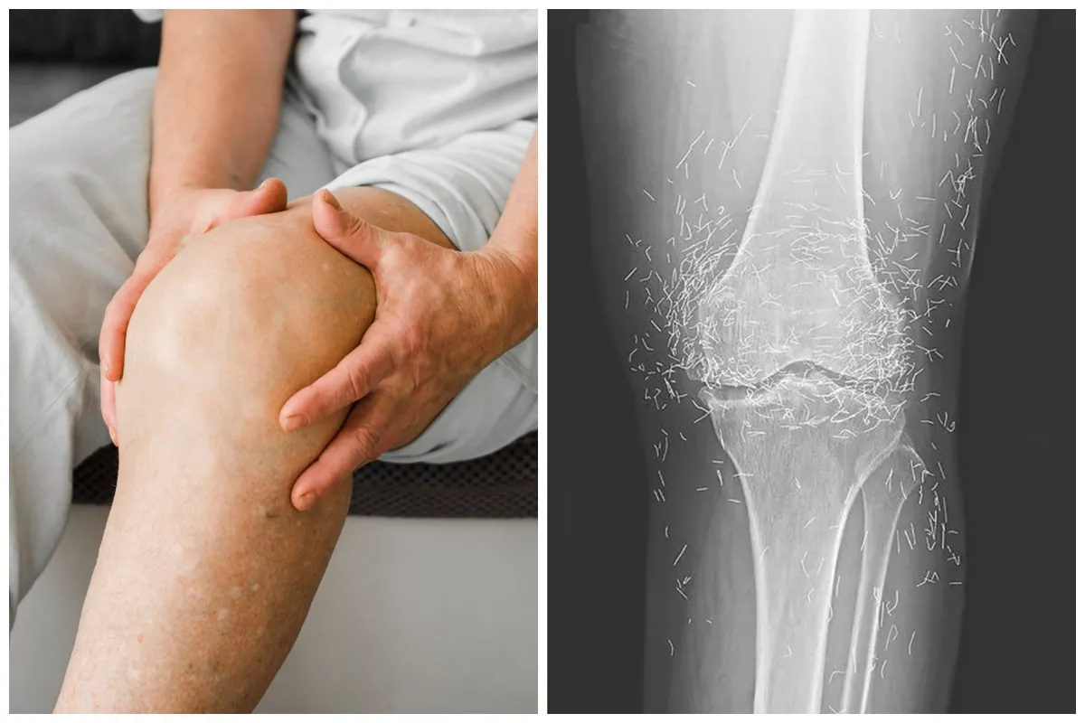 Bikin syok, dokter ini temukan benang susuk emas di lutut pasien saat lakukan rontgen