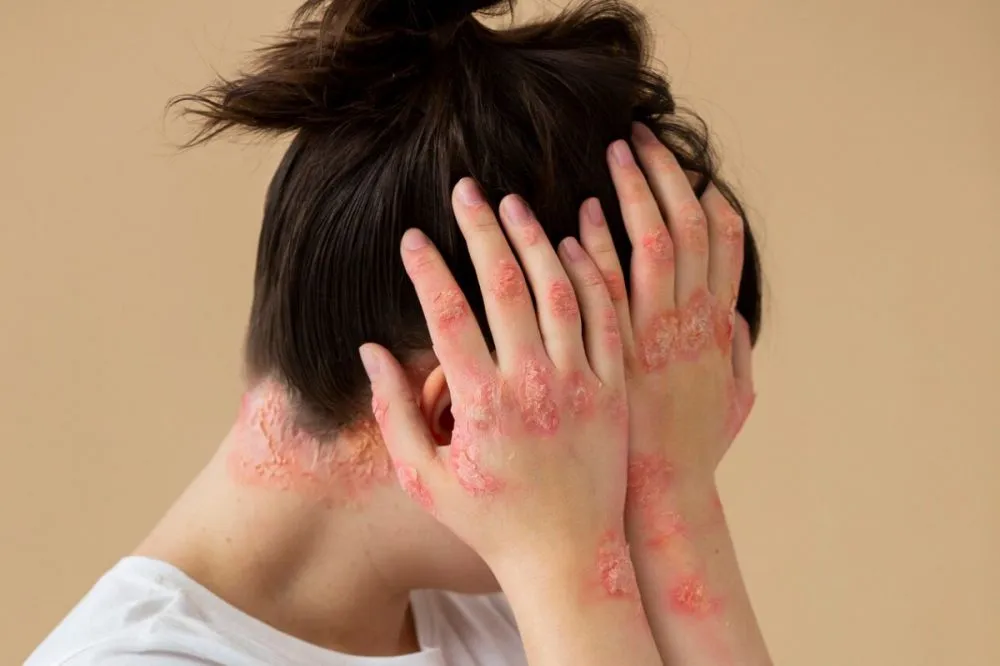 Apa itu herpes © 2025 brilio.net