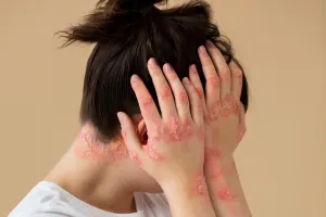 Apa itu herpes? Pengertian, jenis, ciri-ciri, serta cara mengatasinya dengan tepat