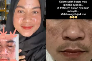 Merkuri bikin flek hitam, kisah perjuangan emak-emak cerahkan wajah saat hamil ini jadi sorotan
