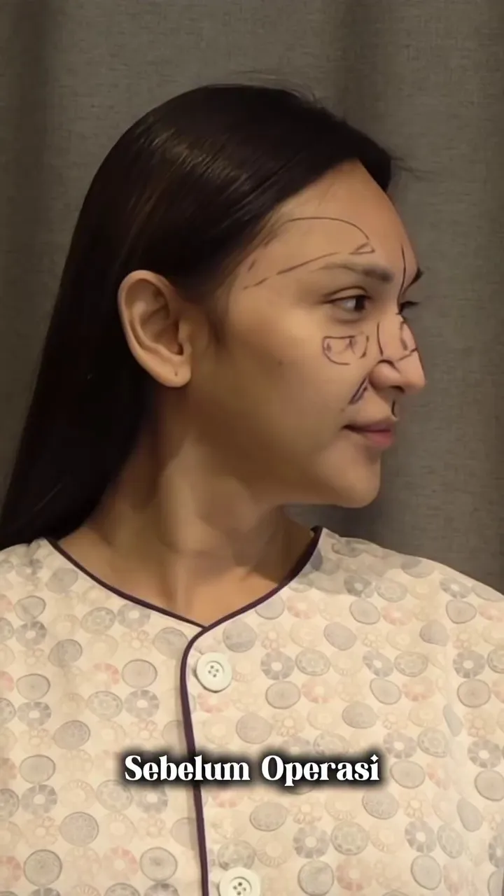 Foto Dena Rachman usai operasi plastik © 2025 Instagram