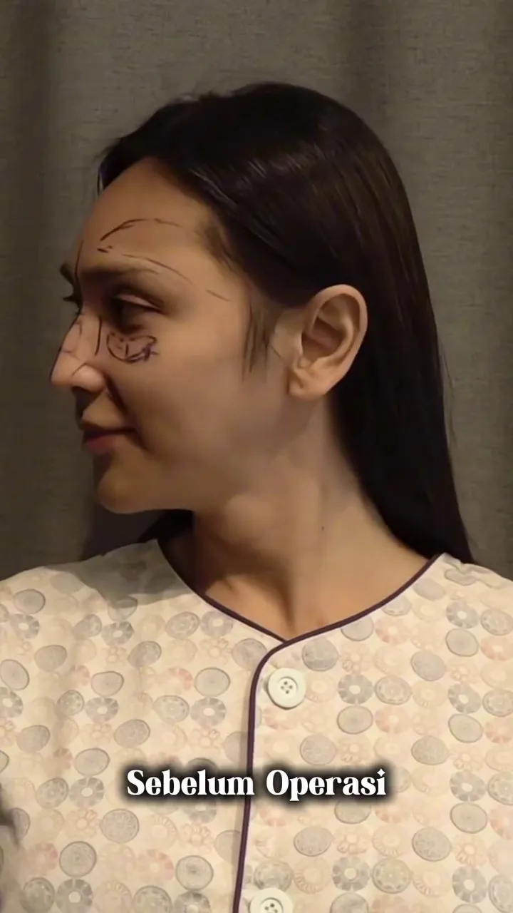 Foto Dena Rachman usai operasi plastik © 2025 Instagram