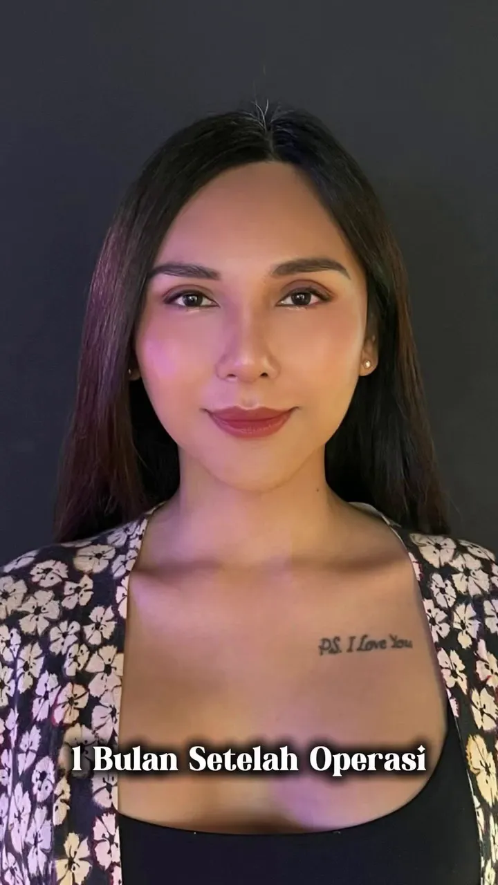 Foto Dena Rachman usai operasi plastik © 2025 Instagram