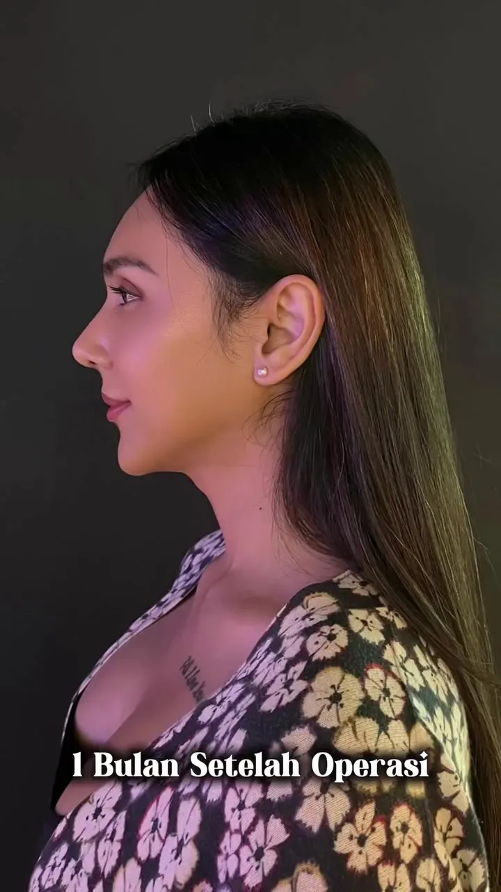 Foto Dena Rachman usai operasi plastik © 2025 Instagram