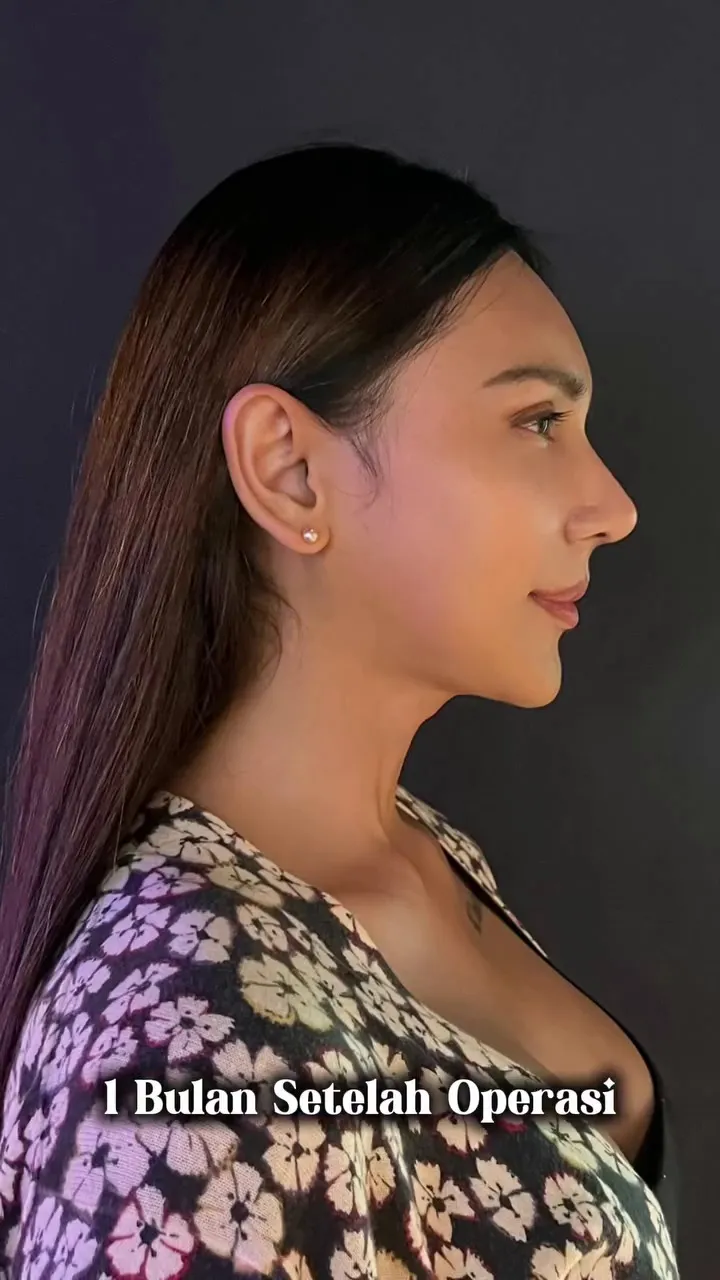Foto Dena Rachman usai operasi plastik © 2025 Instagram