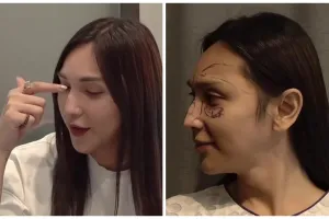 7 Potret Dena Rachman usai operasi plastik bagian hidung, dipuji makin cantik 