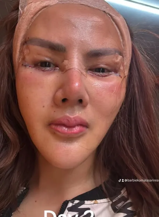 Barbie Kumalasari operasi plastik 8 kali © Instagram