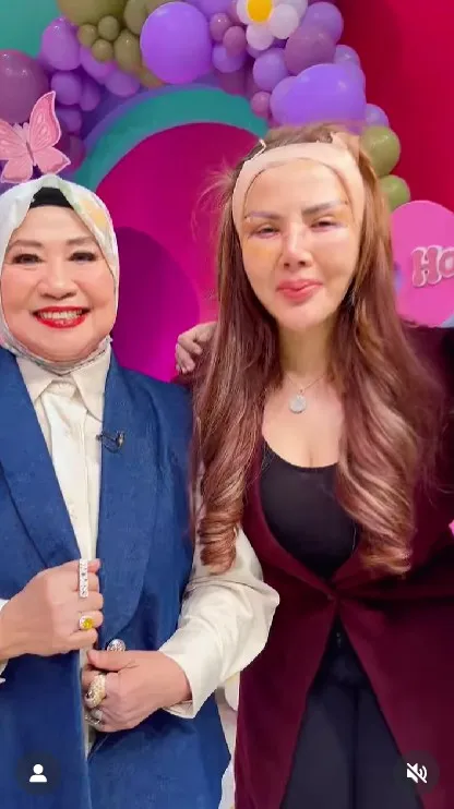Barbie Kumalasari operasi plastik 8 kali © Instagram