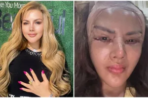 Menolak tua, Barbie Kumalasari sudah jalani operasi plastik 8 kali, ini 7 potret wajahnya kini