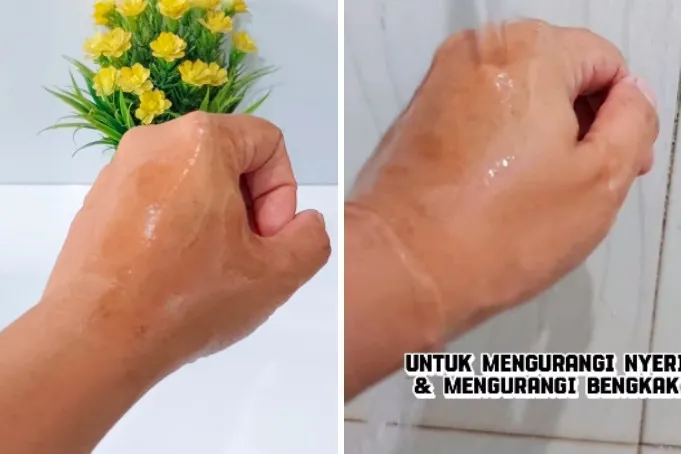 Bukan dioles pasta gigi, ini cara atasi kulit terkena minyak panas agar tak melepuh pakai 1 jenis buah