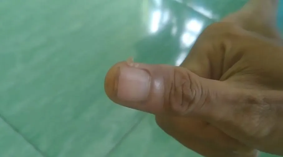 trik hilangkan kulit mengelupas di sekitar kuku berbagai sumber